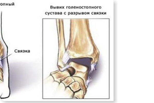 Растяжение связок